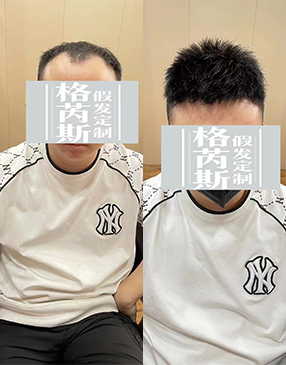 測(cè)量后，與客戶(hù)溝通需要定制的樣式造型和發(fā)長(zhǎng)制定，確定補(bǔ)發(fā)方案
